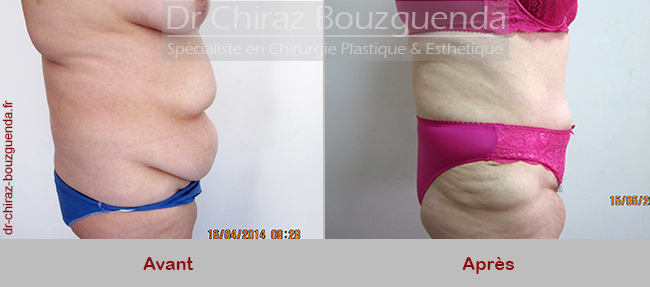 photos abdominoplastie tunisie