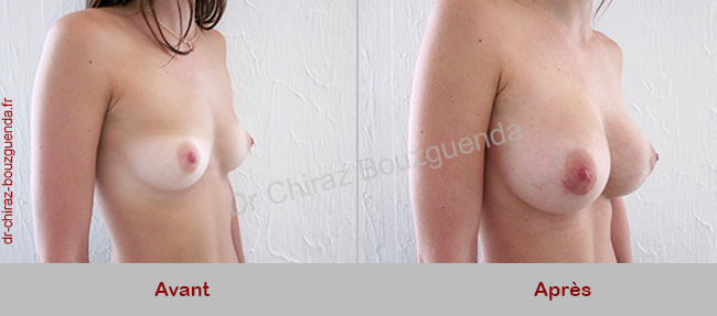 augmentation mammaire tunisie photos avant apres