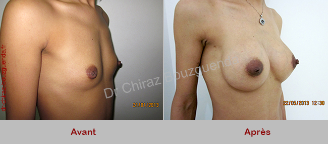 implant mammaire tunisie avant apres tunisie