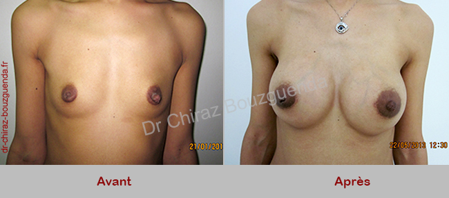 implant mammaire avant apres tunisie