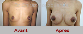 implant mammaire photos avant apres tunisie