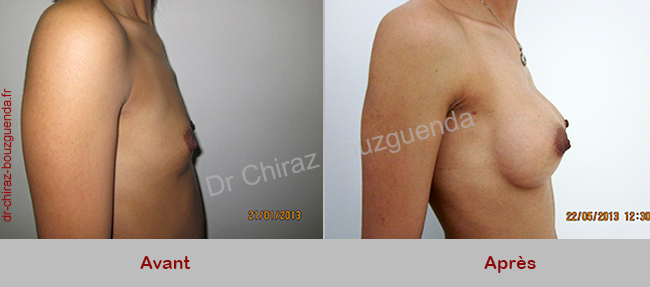 implant mammaire tunisie photos avant apres