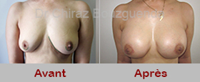 augmentation mammaire photos avant apres tunisie