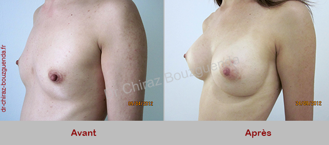 photos avant apres augmentation mammaire tunisie