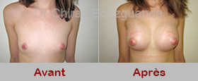photo avant apres augmentation mammaire tunisie
