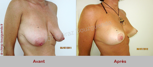 photos lifting mammaire tunisie