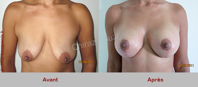 lifting mammaire photos avant apres tunisie