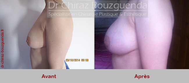 lipofilling mammaire photos avant apres tunisie