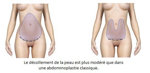 technique abdominoplastie tunisie