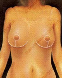 cicatrices reduction mammaire tunisie