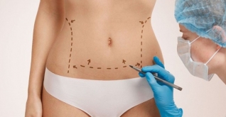 abdominoplastie-haute-tension-superieure