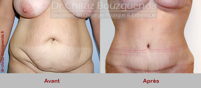 photos abdominoplastie tunisie