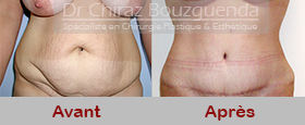 photos avant apres abdominoplastie tunisie