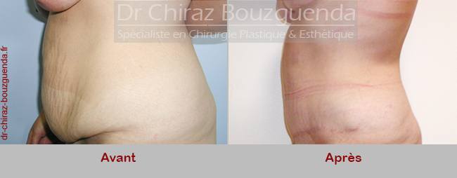 avant apres abdominoplastie tunisie