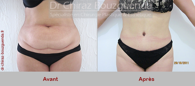 abdominoplastie tunisie photos