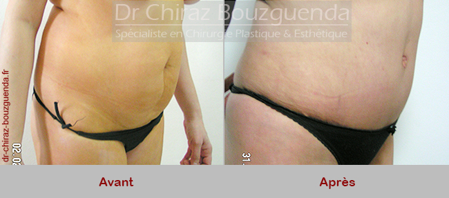 photos abdominoplastie