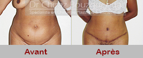 abdominoplastie avant apres