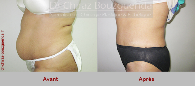 photos chirurgie esthetique ventre tunisie