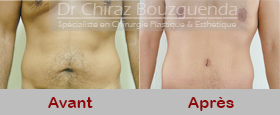 plastie abdominoplastie hommes tunisie photos avant apres