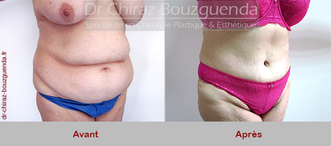 abdominoplastie avant apres