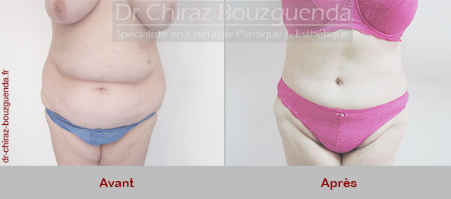 abdominoplastie galerie photos