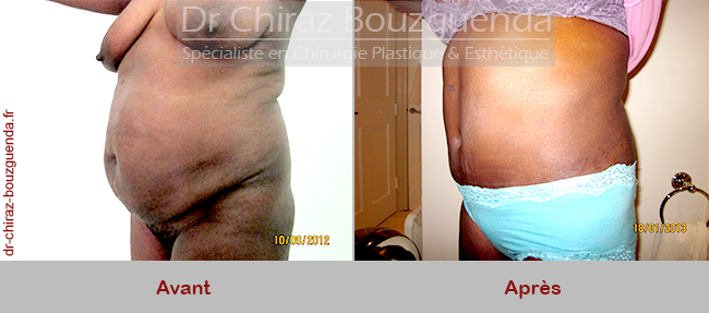 chirurgie abdominale photos avant apres