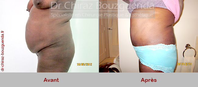 photos chirurgie abdominale tunisie