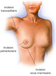implant mammaire tunisie