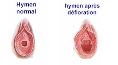 reconstruction hymen tunisie
