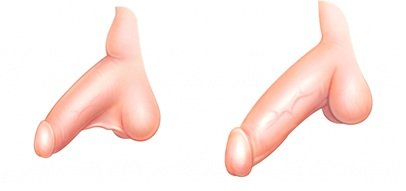 chirurgie augmentation penis tunisie