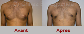 Patient 1 : Photos avant après gynécomastie