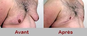 Patient 3 : Photos avant après gynécomastie