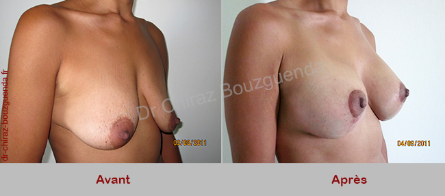 lifting seins tombants photos avant apres tunisie