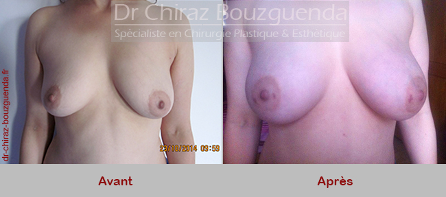 photos avant apres lipofilling seins tunisie