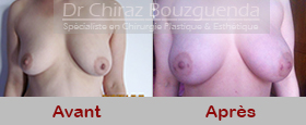 photos avant apres lipofilling mammaire tunisie