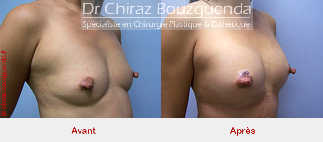 photos  augmentation mammaire par lipofilling tunisie