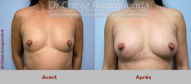 photos lipofilling mammaire tunisie