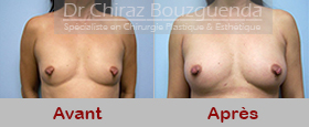 photos lipofilling seins tunisie