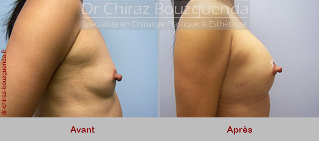 photos avant apres augmentation mammaire par lipofilling tunisie