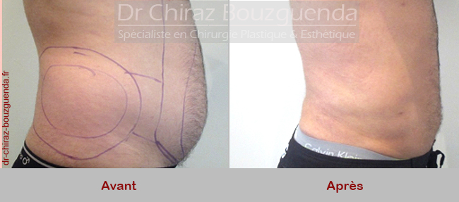 liposuccion hommes tunisie photos avant apres 