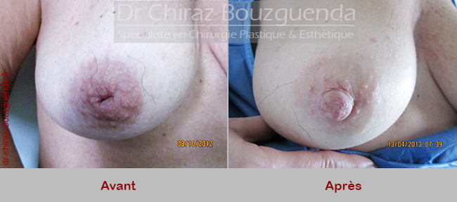 photos avant apres chirurgie mamelons ombiliques tunisie