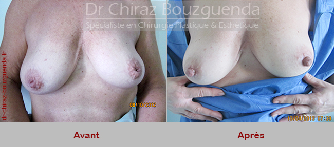 photos chirurgie mamelons invagines tunisie