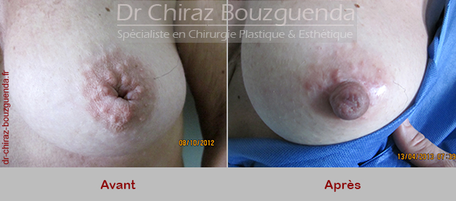 chirurgie mamelons invagines tunisie photos avant apres