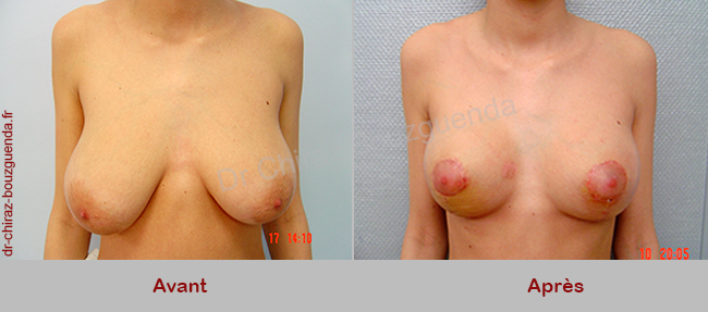 photos avant apres reduction mammaire