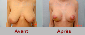 reduction mammaire photos avant apres tunisie
