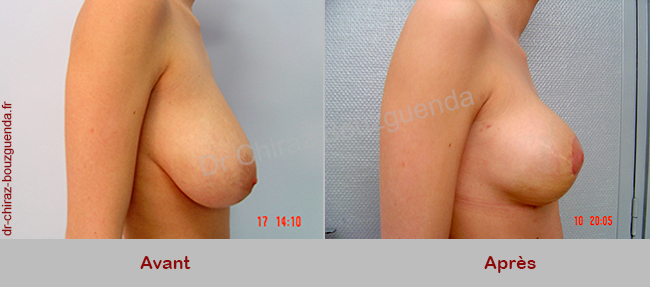 reduction mammaire photos avant apres