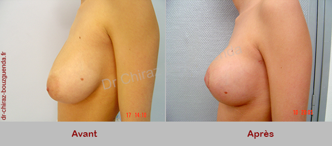 photos reduction mammaire tunisie