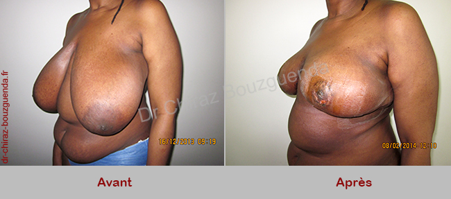 photos reduction mammaire avant apres tunisie