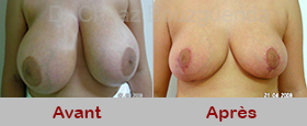 photos reduction mammaire avant apres tunisie
