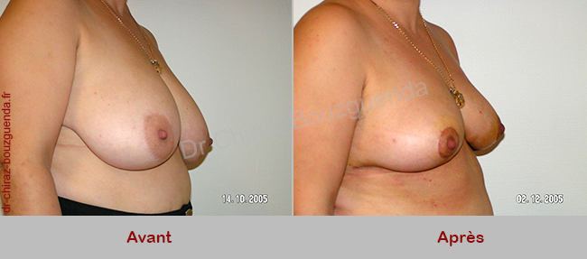 photos reduction mammaire tunisie avant apres